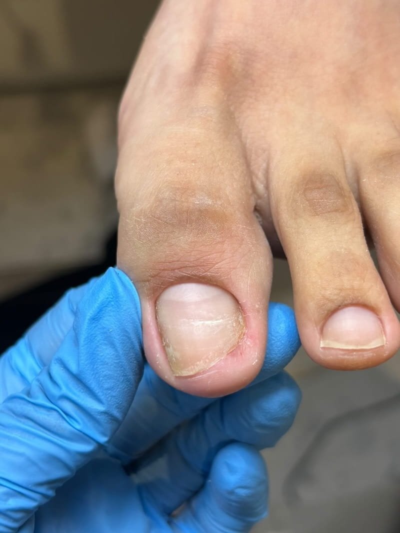 Before CMP Pedicure and toenail reconstruction at Nail Art House