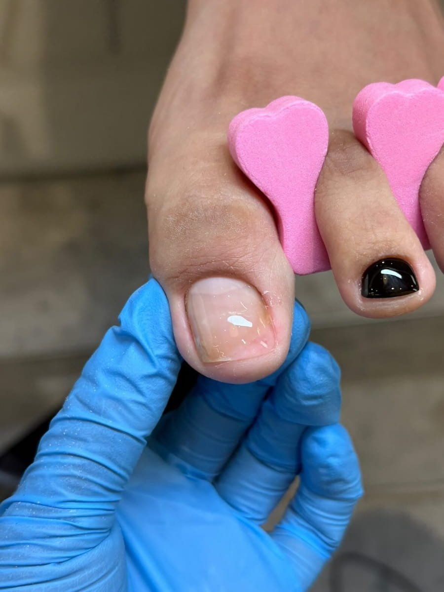 Nanoflex toenail reconstruction at Nail Art House